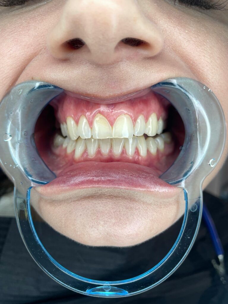 pexels-photo-15073697-15073697 Detailed view of teeth during a dental checkup using a retractor device.
