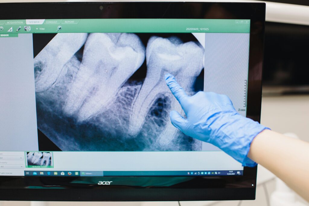 pexels-photo-4687290-4687290 Close-up of a dental X-ray displayed on a monitor with a gloved hand pointing.