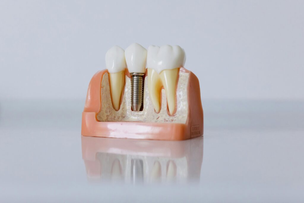 dental implant Detailed dental implant model showcasing teeth structure